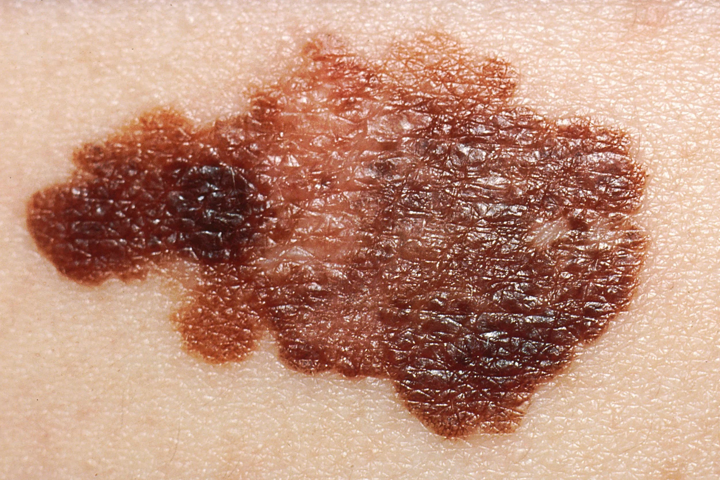 Mohs surgery skin cancer treatment